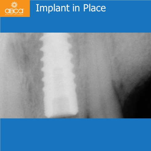 Extraction, Augma and Implants