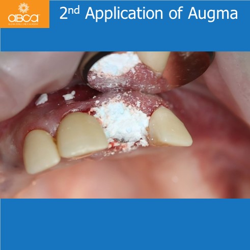 Extraction, Augma and Implants