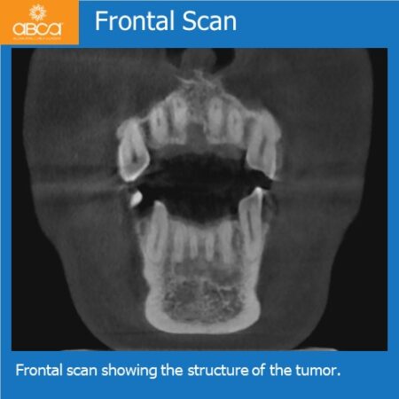 Large Central Ossifying Fibroma of the Anterior Mandible
