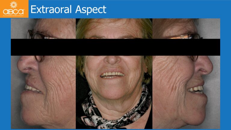 Mandible Full Arch Rehabilitation with an Immediate All-on-5 and Immediate Load
