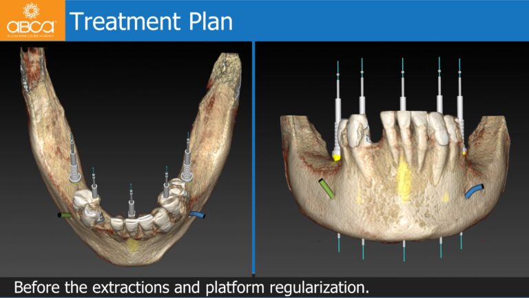 Mandible Full Arch Rehabilitation with an Immediate All-on-5 and Immediate Load