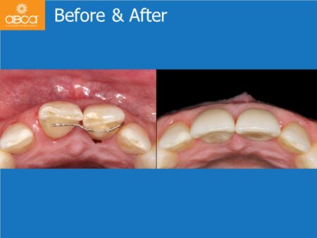 Immediate Implants of the 2 Upper Central Incisors with Immediate Load
