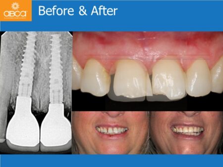 Immediate Implants of the 2 Upper Central Incisors with Immediate Load