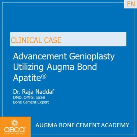 Advancement Genioplasty Utilizing Augma Bond Apatite