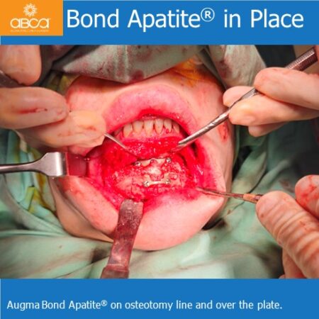 Advancement Genioplasty Utilizing Augma Bond Apatite