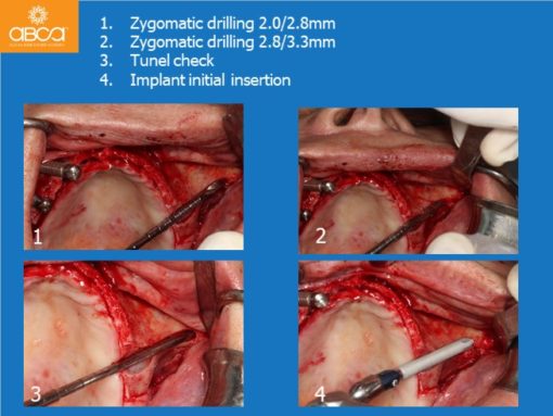 Zygomatic Implants & Bond Apatite Grafting