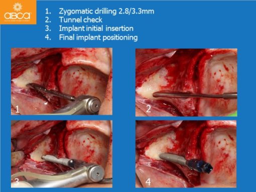 Zygomatic Implants & Bond Apatite Grafting