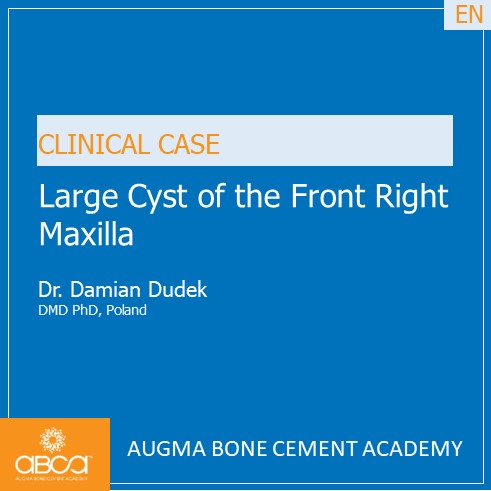 Large Cyst of the Front Right Maxilla