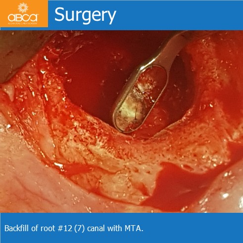 Large Cyst of the Front Right Maxilla