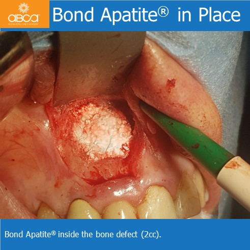 Large Cyst of the Front Right Maxilla