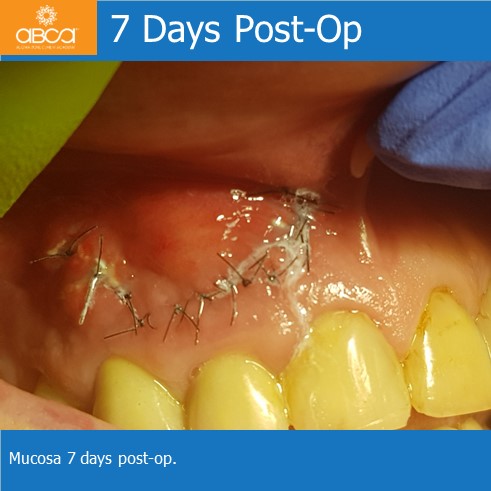 Large Cyst of the Front Right Maxilla