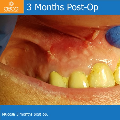 Large Cyst of the Front Right Maxilla