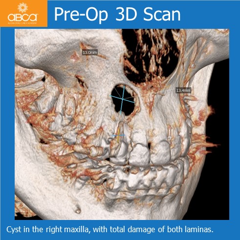 Large Cyst of the Front Right Maxilla