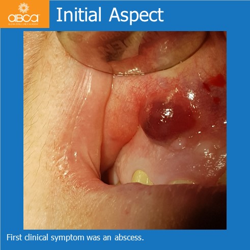 Large Cyst of the Front Right Maxilla