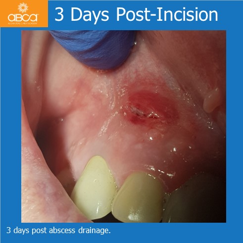 Large Cyst of the Front Right Maxilla