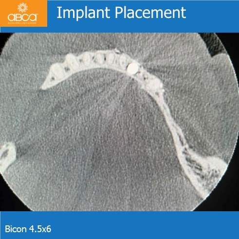 Implant Placement | Bicon 4.5x6