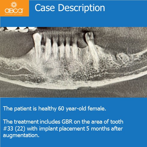 Case Description | The patient is healthy 60 year-old female. The treatment includes BR on the area of tooth #33 (22) with implant placement 5 months after augmentation.