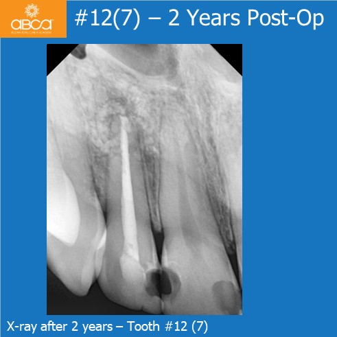 X-ray after 2 years - Tooth #12 (7)