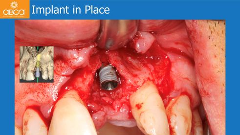 Implant in Place