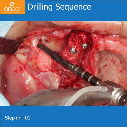 Drilling Sequence | Step drill 01