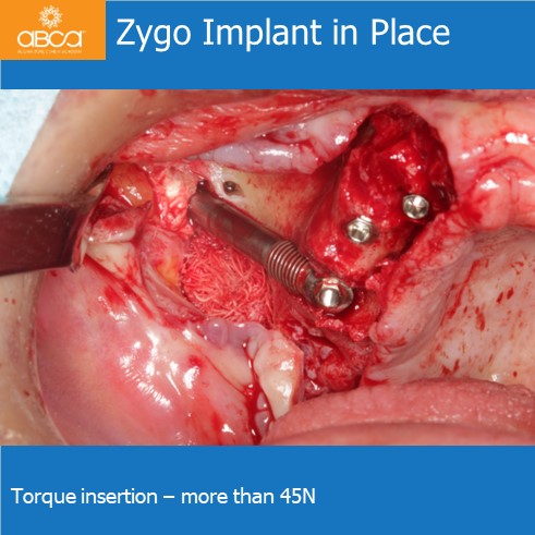 Zygo Implant in Place | Torque insertion - more than 45N