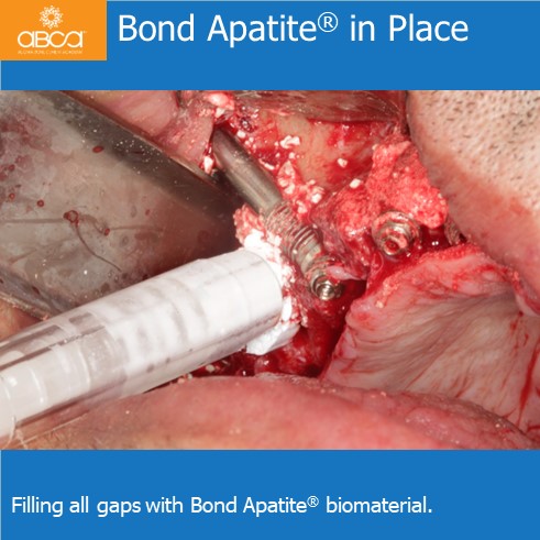 Bond Apatite in Place | Filling all gaps with Bond Apatite biomaterial.