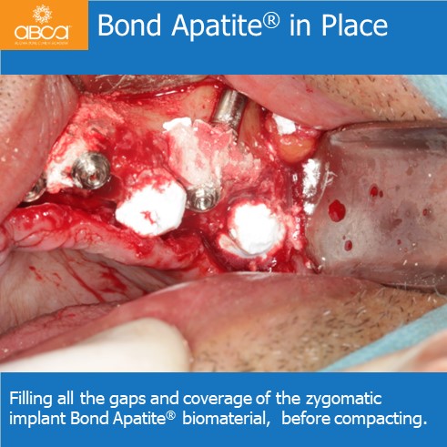 Bond Apatite in Place | Filling all the gaps and coverage of the zygomatic implant Bond Apatite biomaterial, before compacting.