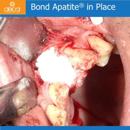 Extraction and Cyst Enucleation  Tooth #22 (10)