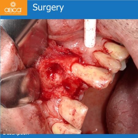 Extraction and Cyst Enucleation  Tooth #22 (10)