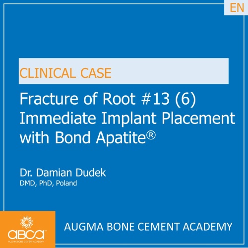 Fracture of Root #13 (6) Immediate Implant Placement with Bond Apatite