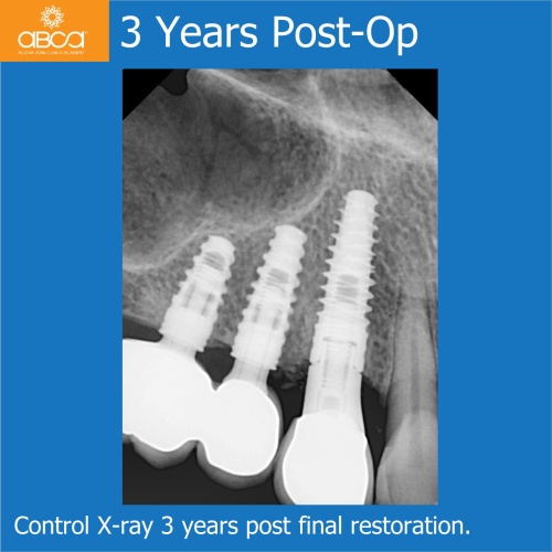 Fracture of Root #13 (6) Immediate Implant Placement with Bond Apatite