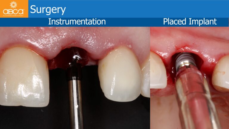 Immediate Implant of the Left Central Incisor Using the PET Technique & Immediate Loading
