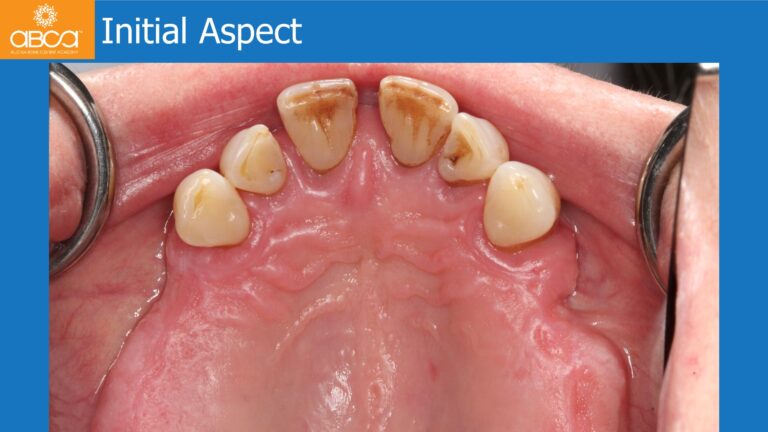 Full Arch Rehabilitation of the Maxilla with an Immediate All-on-4