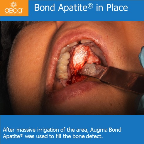 Expansive Lesion of the Right Maxilla Extraction and Immediate Reconstruction with Augma Bond Apatite