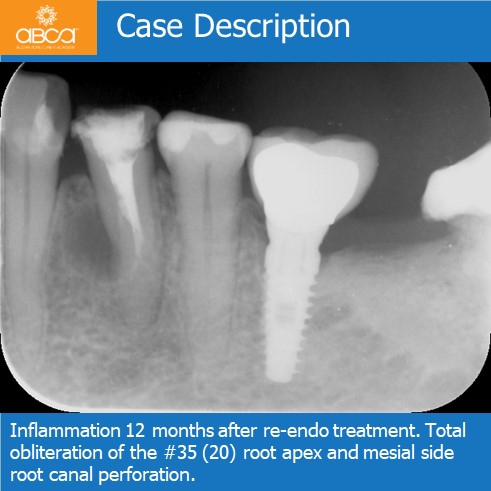 Complications in Endo Treatment  Root Canal Perforation #35 (20)